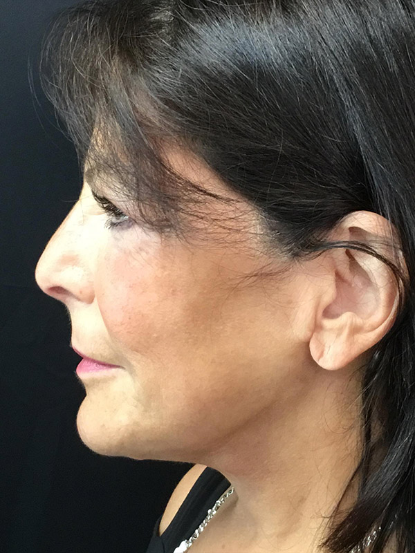 Neck Lift Before and After | Montilla Plastic Surgery 
