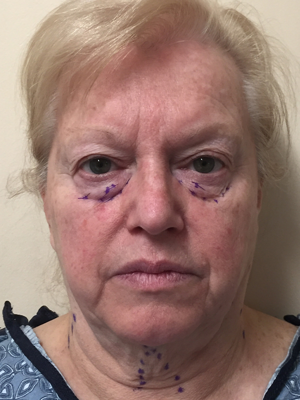 Neck Lift Before and After | Montilla Plastic Surgery 