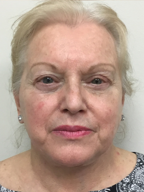 Neck Lift Before and After | Montilla Plastic Surgery 