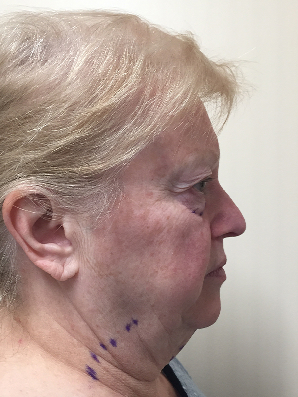 Neck Lift Before and After | Montilla Plastic Surgery