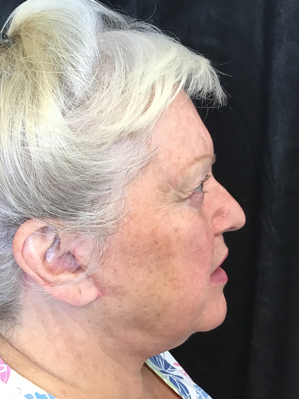 Neck Lift Before and After | Montilla Plastic Surgery