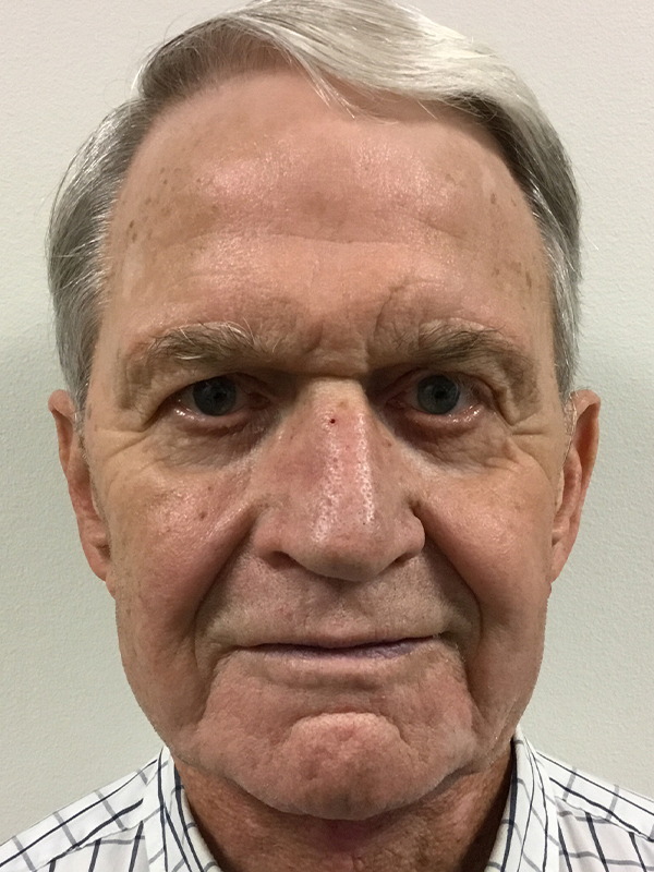 Neck Lift Before and After | Montilla Plastic Surgery 