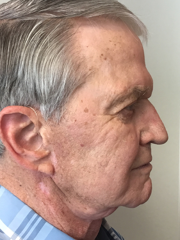 Neck Lift Before and After | Montilla Plastic Surgery