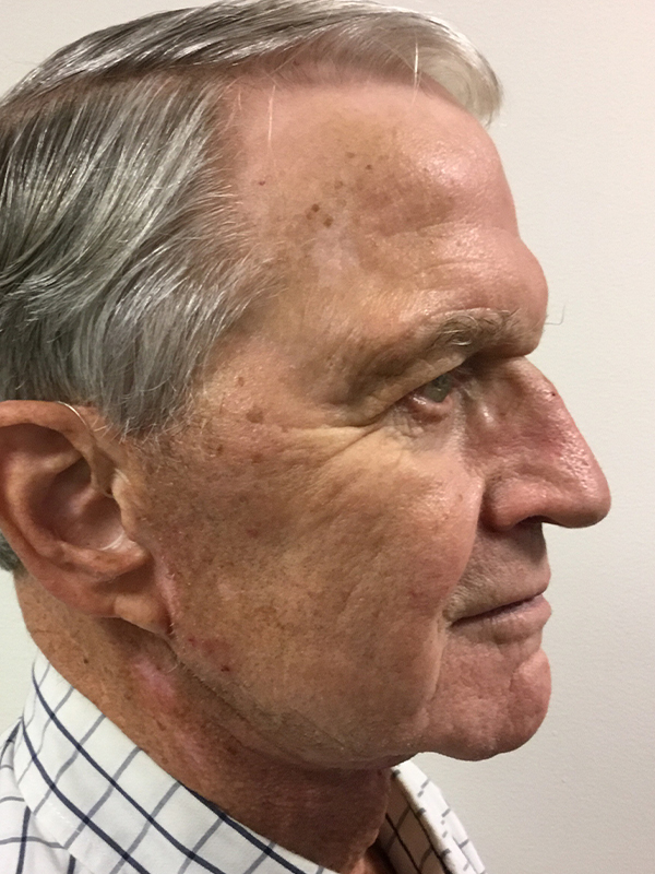 Neck Lift Before and After | Montilla Plastic Surgery