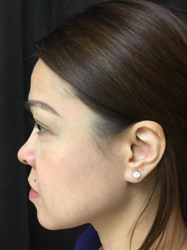 Nose Fillers Before and After | Montilla Plastic Surgery