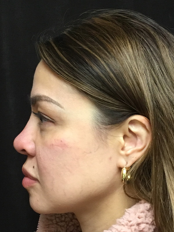 Nose Fillers Before and After | Montilla Plastic Surgery