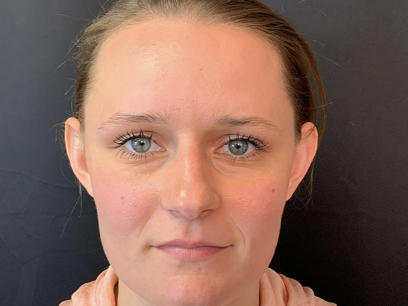 Otoplasty Before and After | Montilla Plastic Surgery