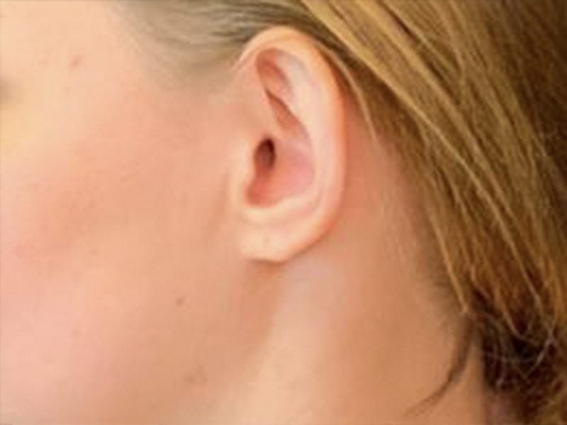 Otoplasty Before and After | Montilla Plastic Surgery