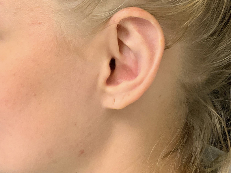 Otoplasty Before and After | Montilla Plastic Surgery