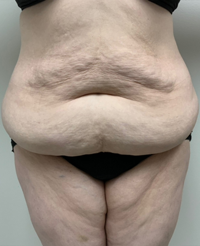 Panniculectomy Before and After | Montilla Plastic Surgery 