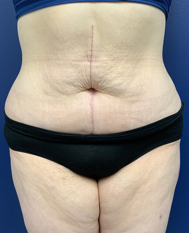 Panniculectomy Before and After | Montilla Plastic Surgery 