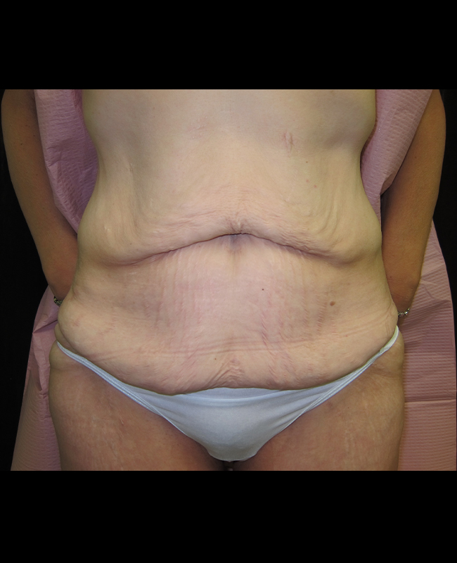 Panniculectomy Before and After | Montilla Plastic Surgery 