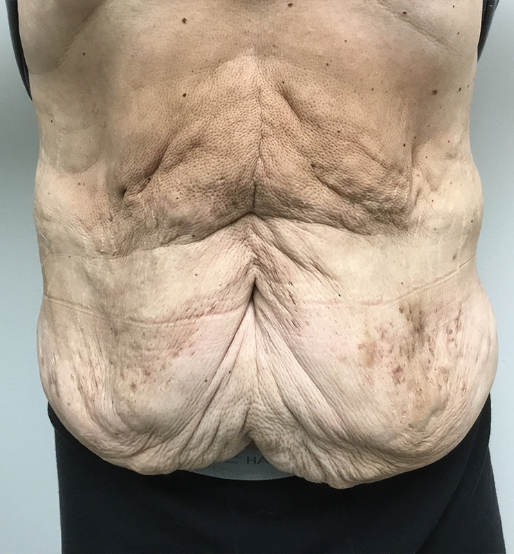 Panniculectomy Before and After | Montilla Plastic Surgery 