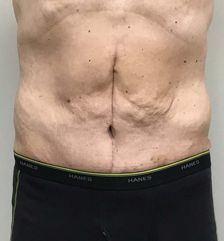 Panniculectomy Before and After | Montilla Plastic Surgery 