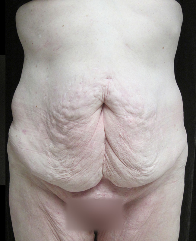 Panniculectomy Before and After | Montilla Plastic Surgery 