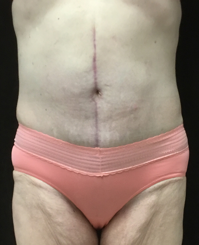 Panniculectomy Before and After | Montilla Plastic Surgery 