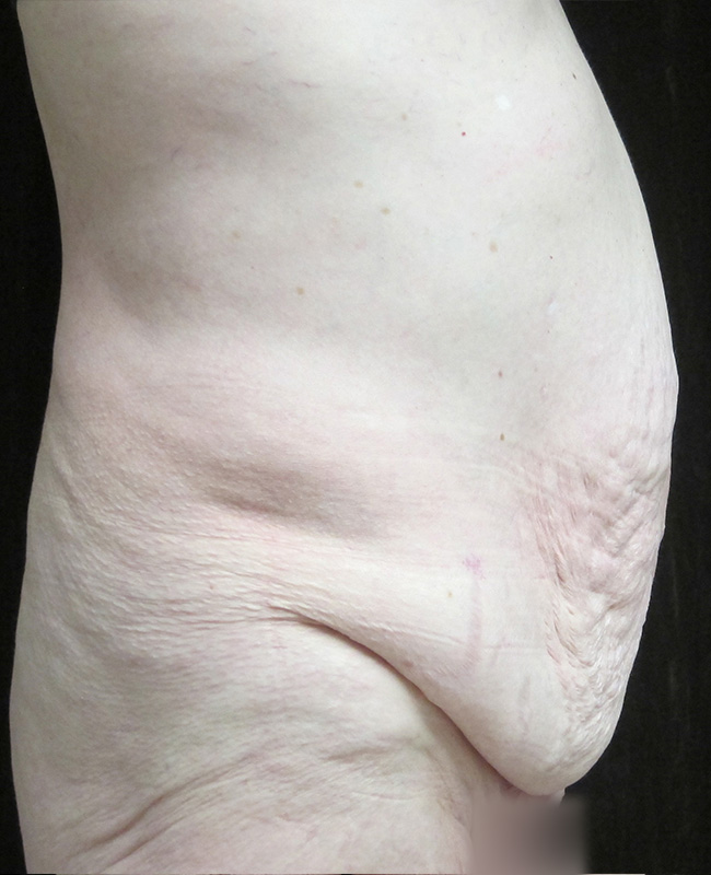 Panniculectomy Before and After | Montilla Plastic Surgery 