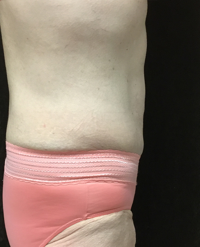 Panniculectomy Before and After | Montilla Plastic Surgery 