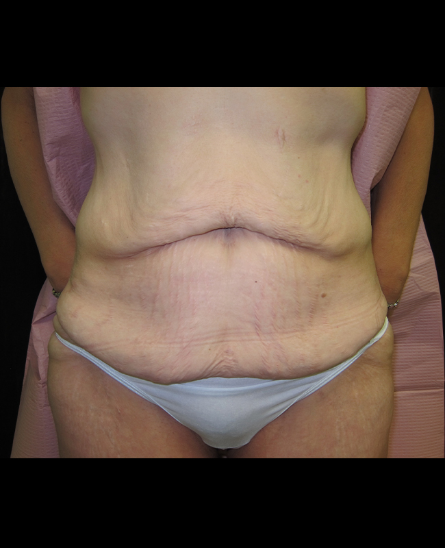 Panniculectomy Before and After | Montilla Plastic Surgery