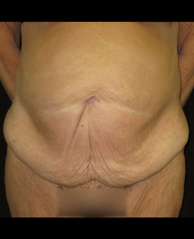 Panniculectomy Before and After | Montilla Plastic Surgery