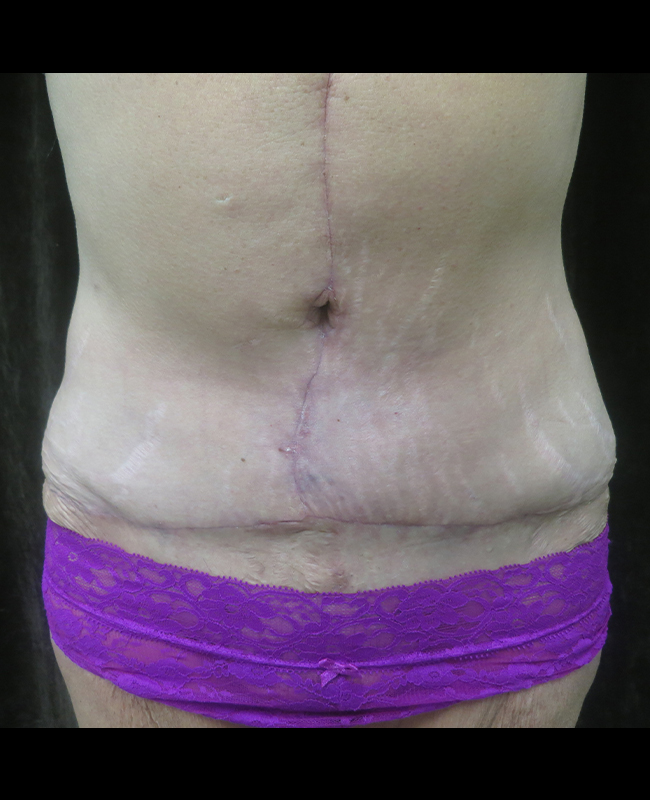 Panniculectomy Before and After | Montilla Plastic Surgery