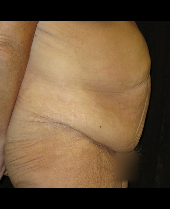 Panniculectomy Before and After | Montilla Plastic Surgery