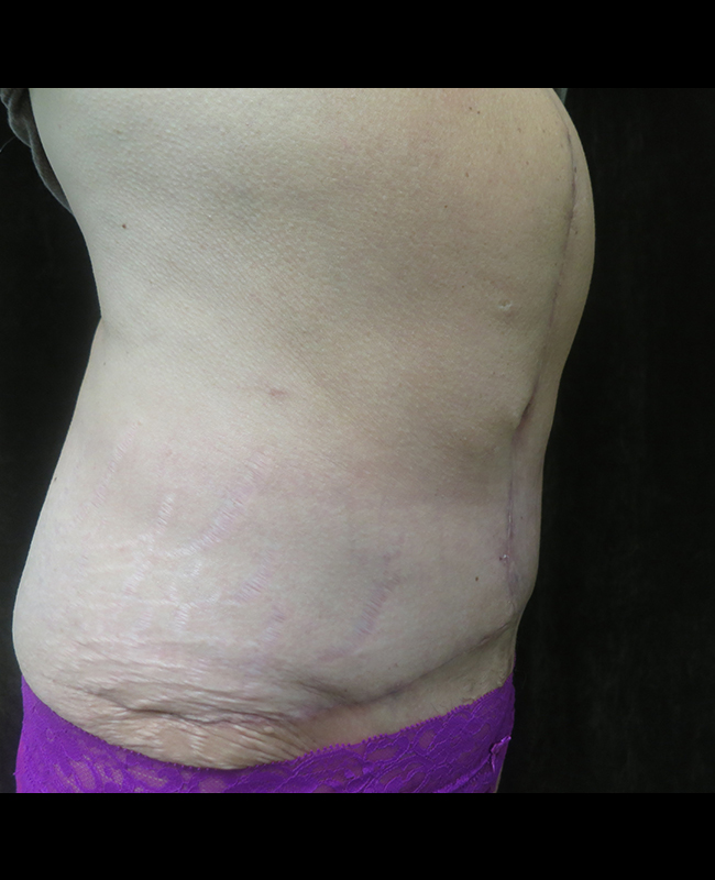 Panniculectomy Before and After | Montilla Plastic Surgery