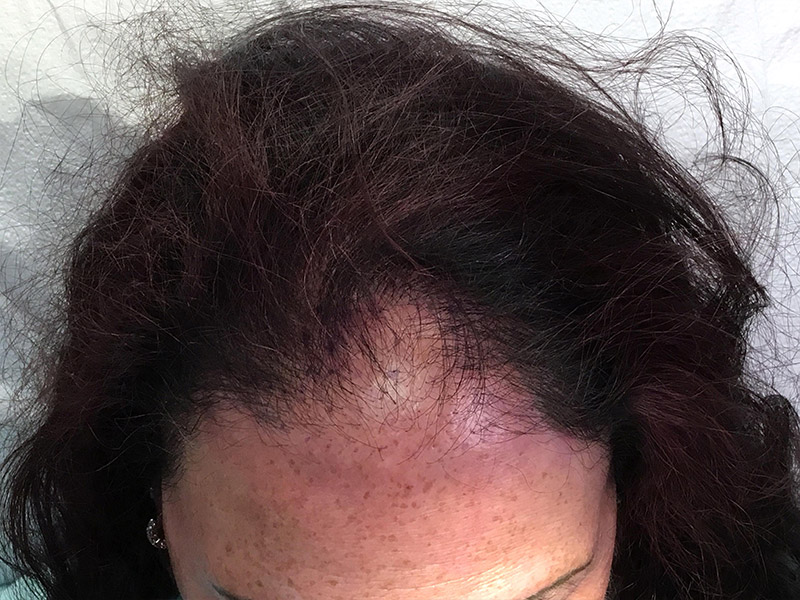 Prp Hair Restoration Before and After | Montilla Plastic Surgery 