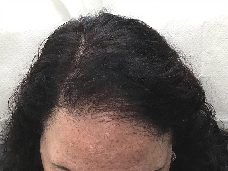 Prp Hair Restoration Before and After | Montilla Plastic Surgery 