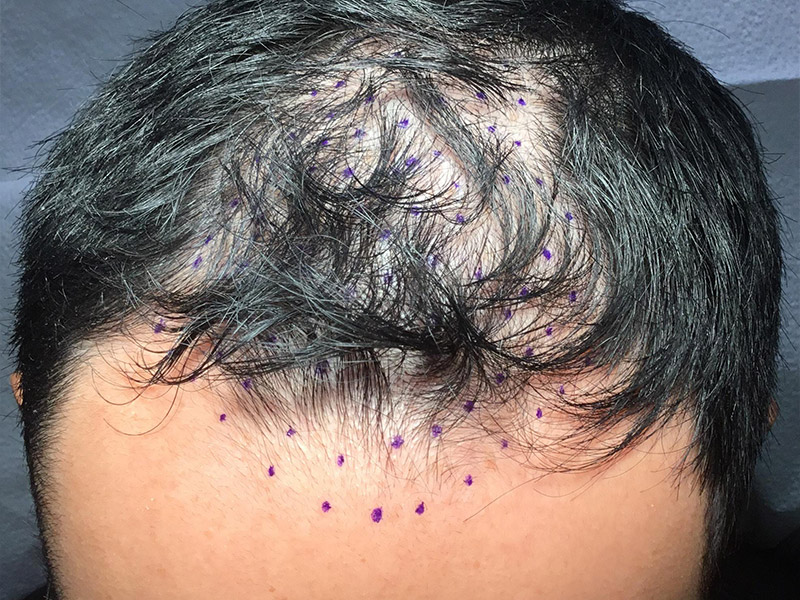 Prp Hair Restoration Before and After | Montilla Plastic Surgery 