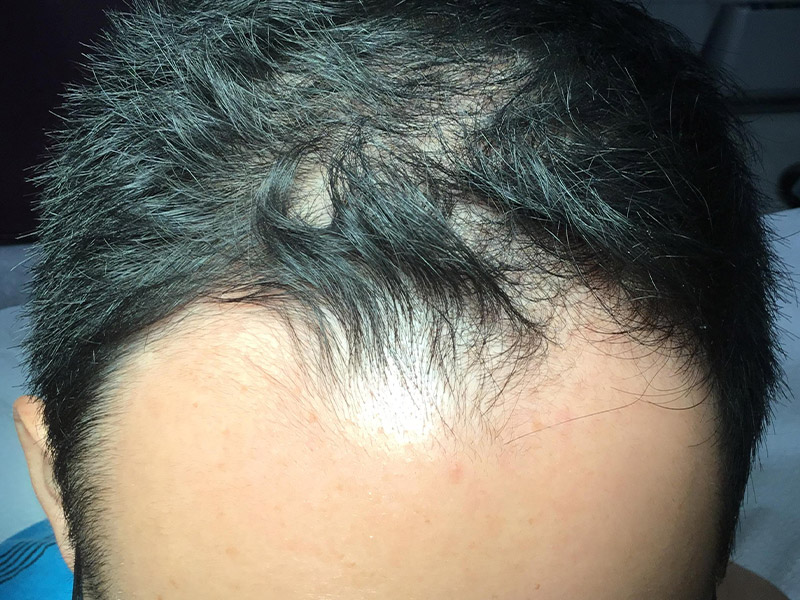 Prp Hair Restoration Before and After | Montilla Plastic Surgery 