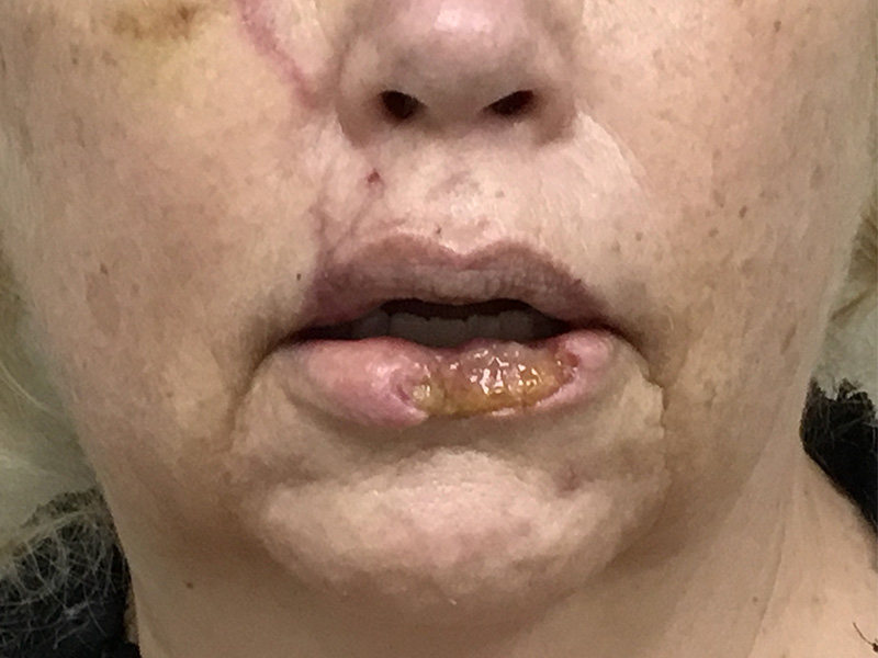 Reconstruction Before and After | Montilla Plastic Surgery