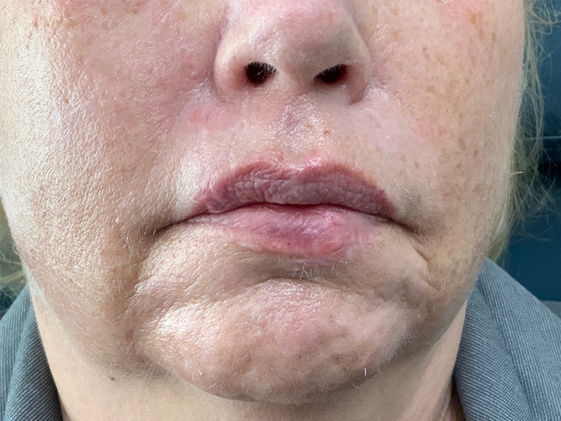 Reconstruction Before and After | Montilla Plastic Surgery