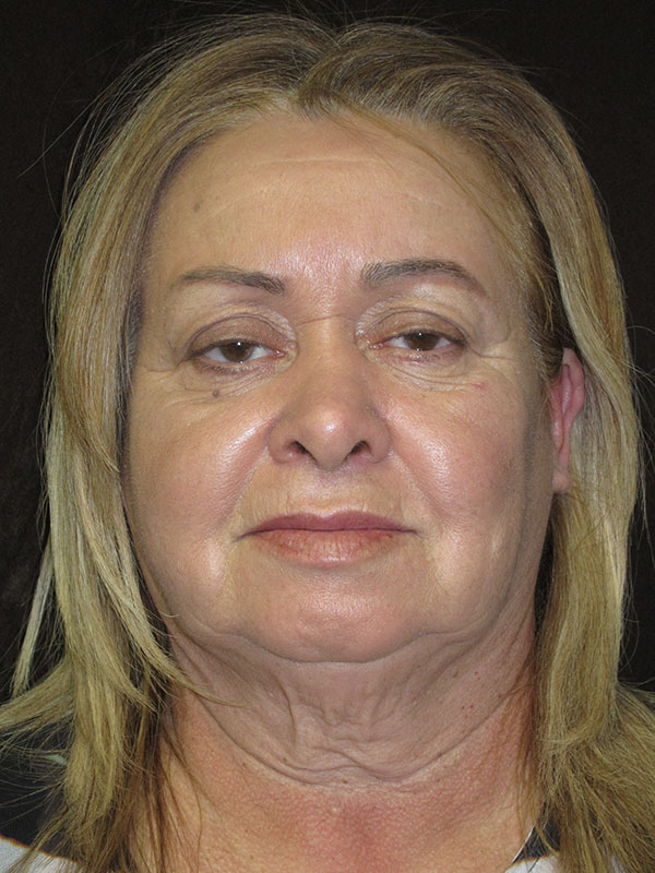 Renuvion Skin Tightening Before and After | Montilla Plastic Surgery 