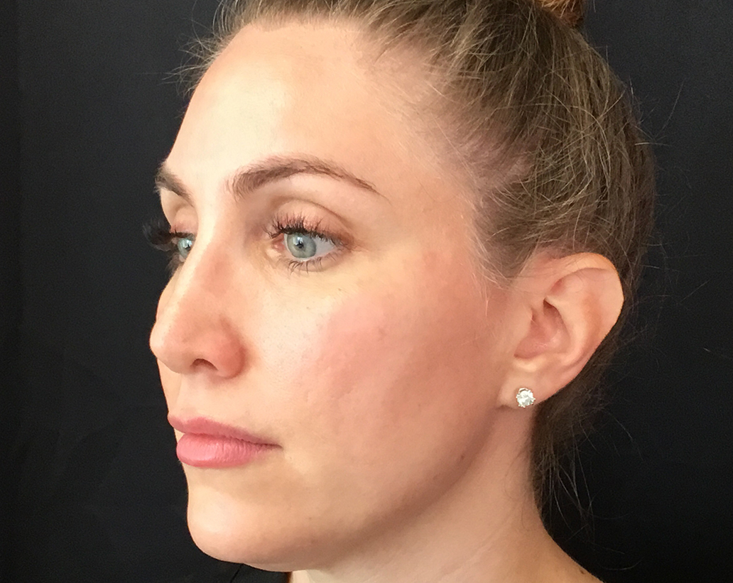 Renuvion Skin Tightening Before and After | Montilla Plastic Surgery 
