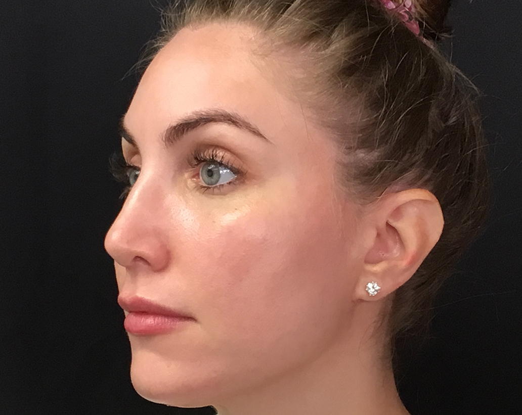 Renuvion Skin Tightening Before and After | Montilla Plastic Surgery 