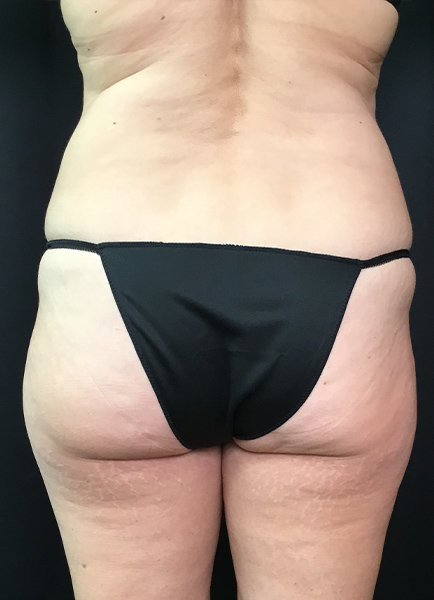 Renuvion Skin Tightening Before and After | Montilla Plastic Surgery 
