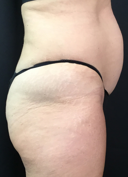 Renuvion Skin Tightening Before and After | Montilla Plastic Surgery 