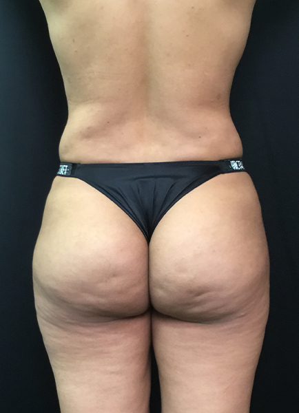 Renuvion Skin Tightening Before and After | Montilla Plastic Surgery 