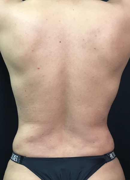 Renuvion Skin Tightening Before and After | Montilla Plastic Surgery