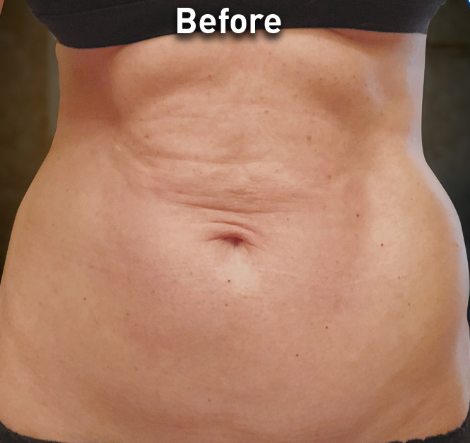 Renuvion Skin Tightening Before and After | Montilla Plastic Surgery 