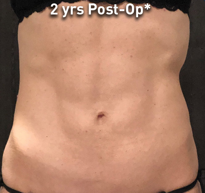 Renuvion Skin Tightening Before and After | Montilla Plastic Surgery 