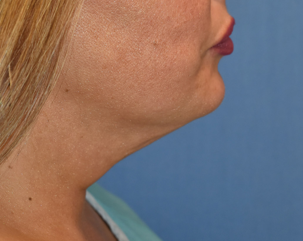 Renuvion Skin Tightening Before and After | Montilla Plastic Surgery 