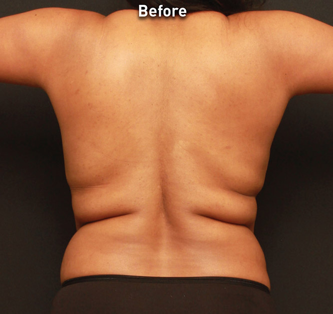 Renuvion Skin Tightening Before and After | Montilla Plastic Surgery 