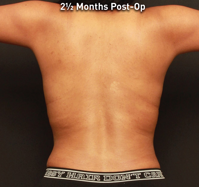 Renuvion Skin Tightening Before and After | Montilla Plastic Surgery 
