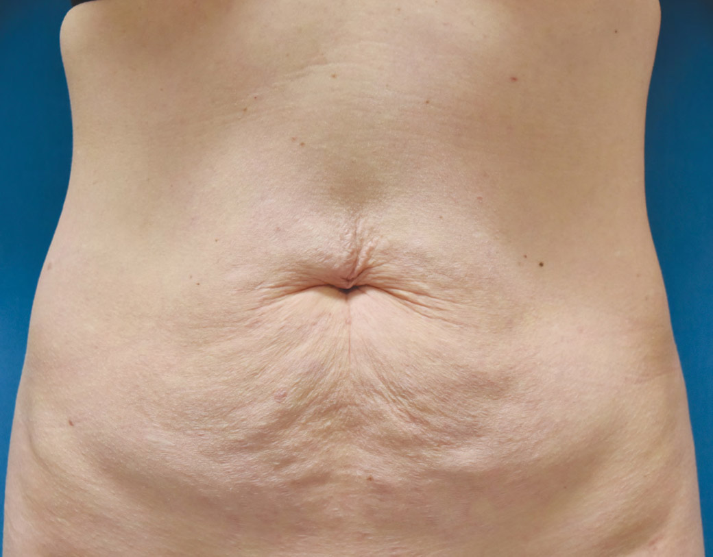 Renuvion Skin Tightening Before and After | Montilla Plastic Surgery 