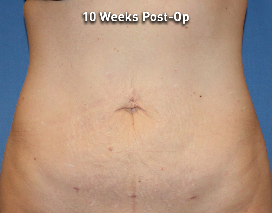 Renuvion Skin Tightening Before and After | Montilla Plastic Surgery 