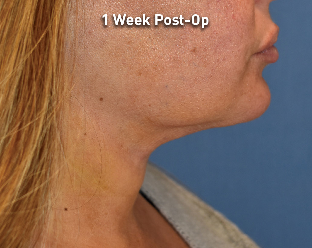 Renuvion Skin Tightening Before and After | Montilla Plastic Surgery 