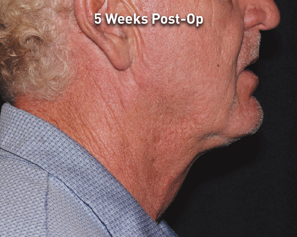 Renuvion Skin Tightening Before and After | Montilla Plastic Surgery