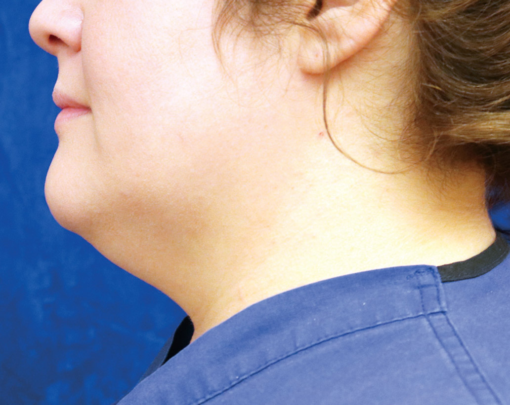 Renuvion Skin Tightening Before and After | Montilla Plastic Surgery 